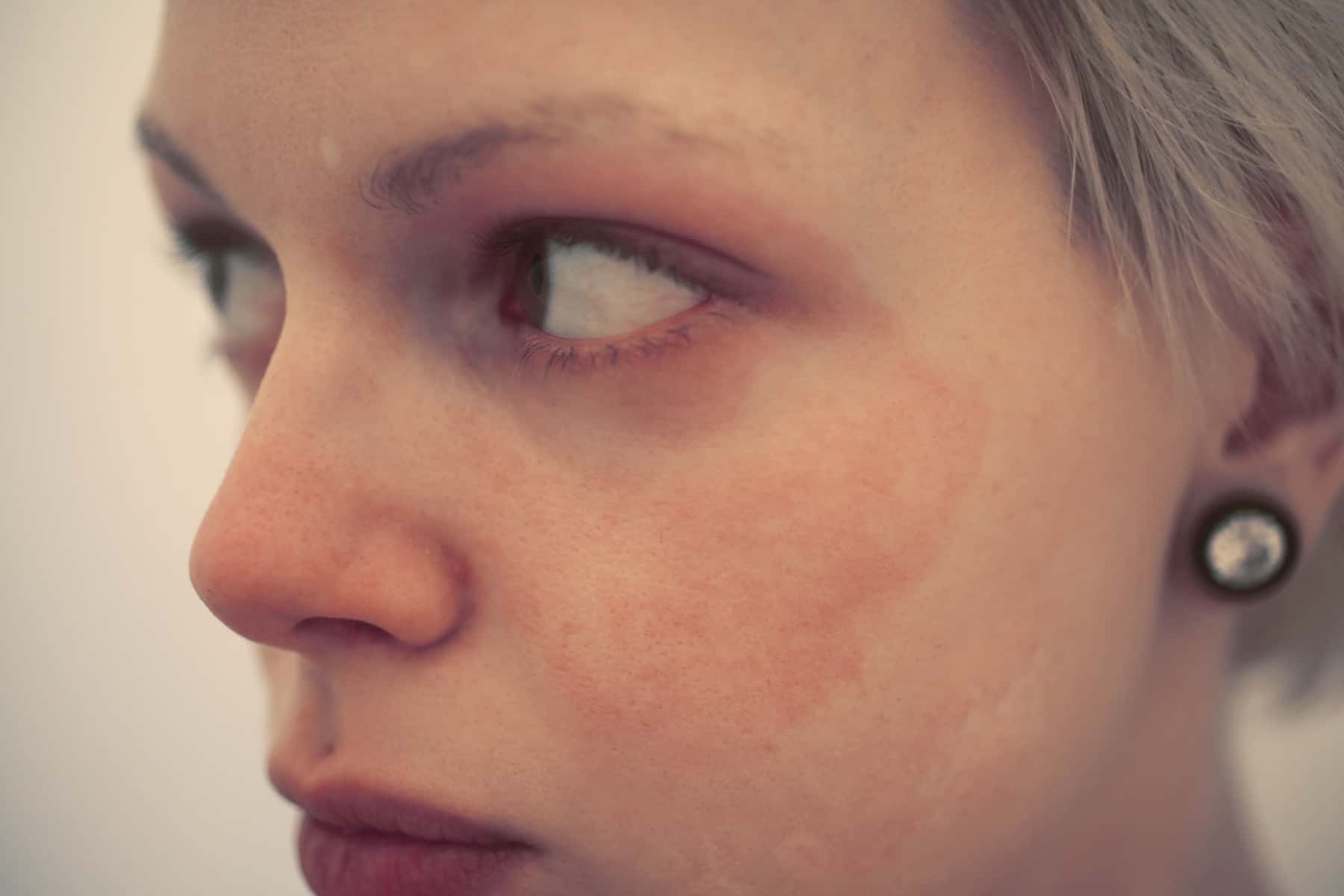 a woman with skin allergy