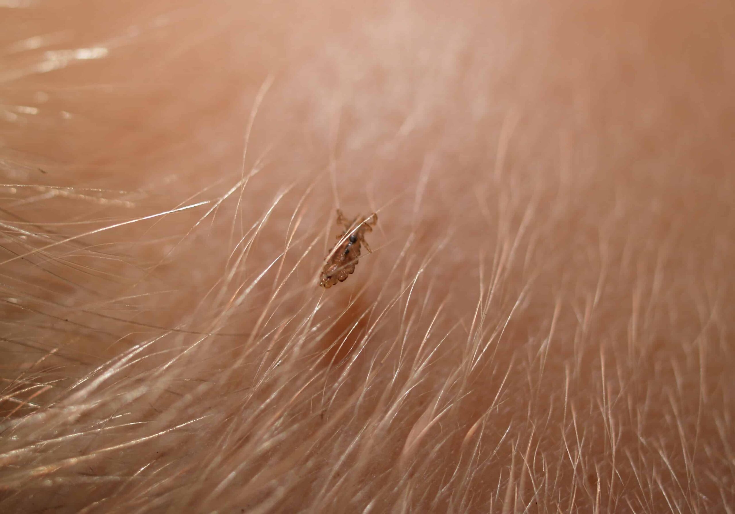 lice found in the head