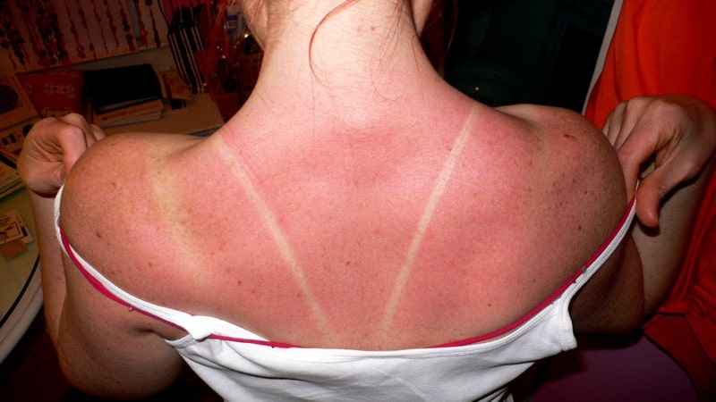 sunburned skin