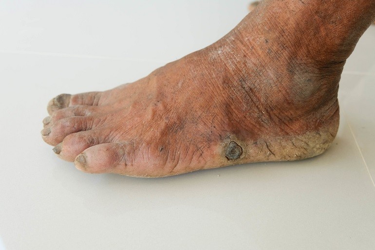 Diabetic Neuropathy